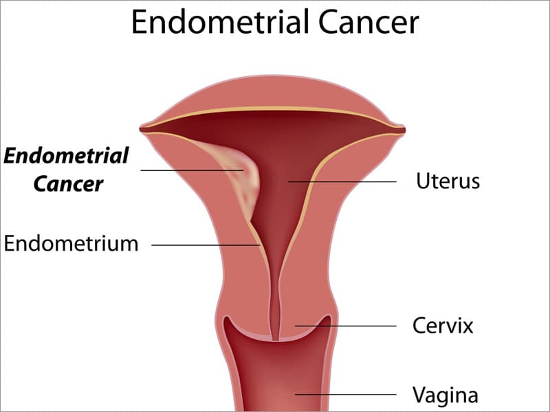 Image result for endometrial cancer