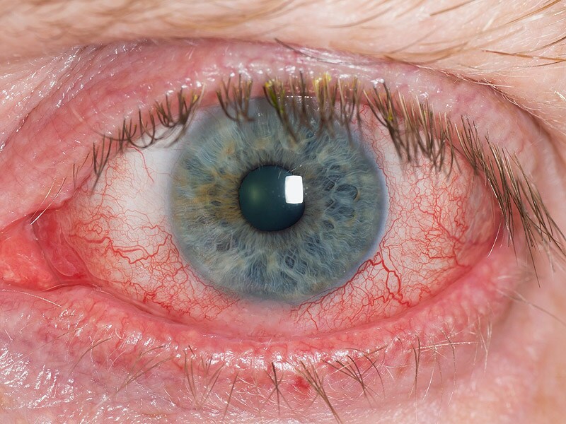 refractory-dry-eye-linked-with-neuropathic-or-systemic-pain