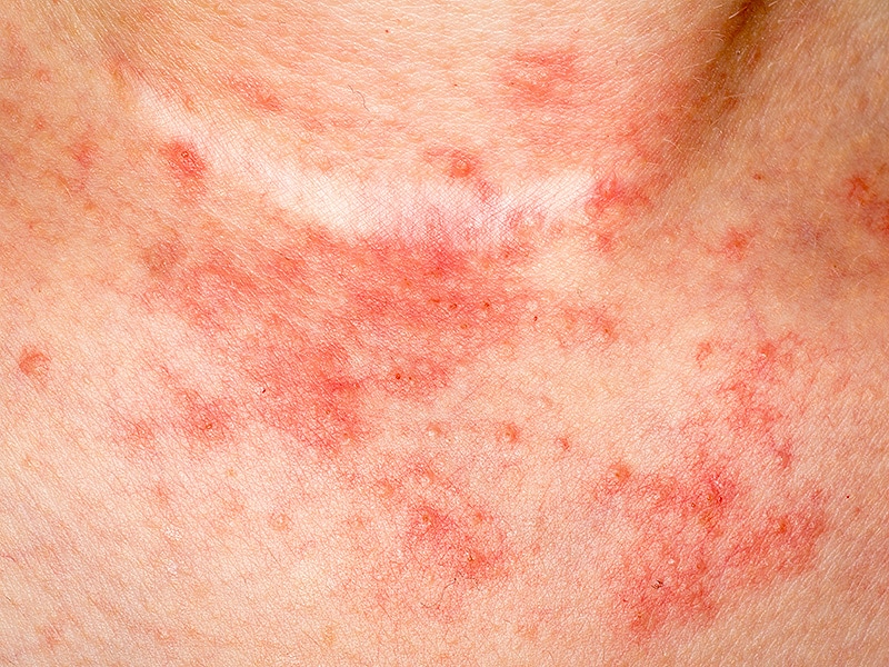 Symptoms of Paraben mix allergy - RightDiagnosis.com