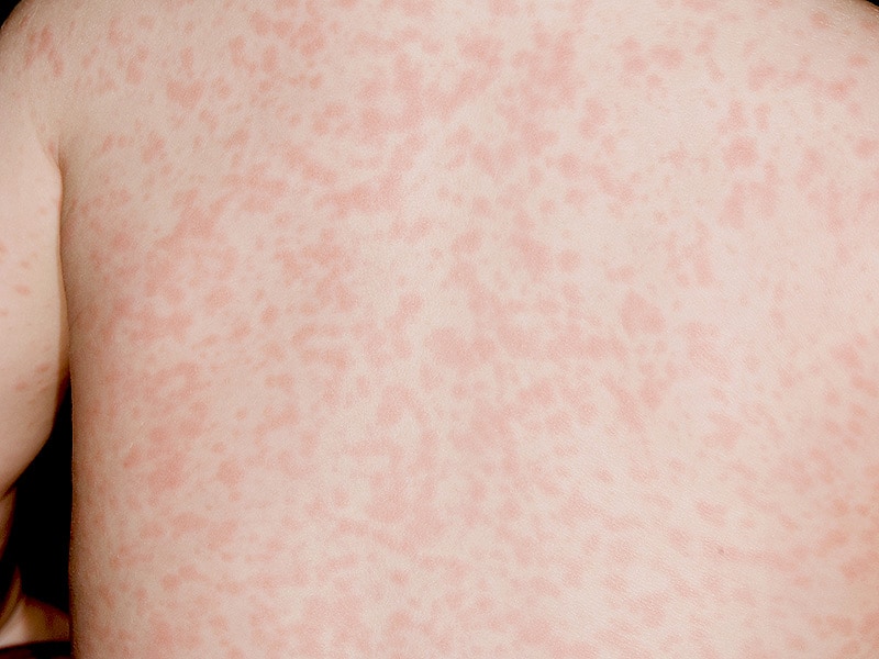 Measles Symptoms - Measles Home Page