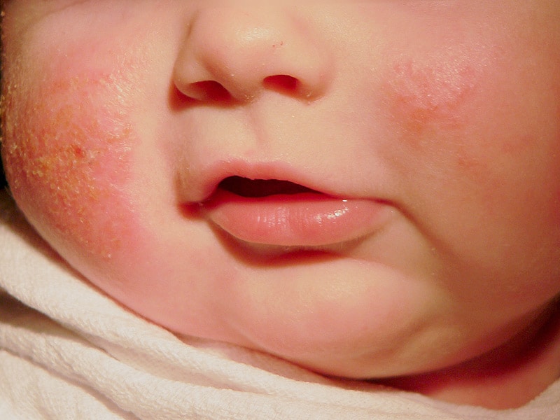 Twin Infants With Rashes Same Diagnosis