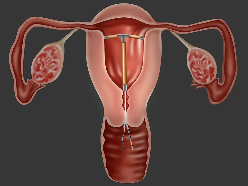 Experimental Nitinol IUD May Cause Less Pain