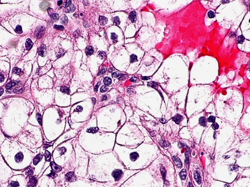 Combo PD1 and VEFGR Inhibitor Active in Advanced RCC