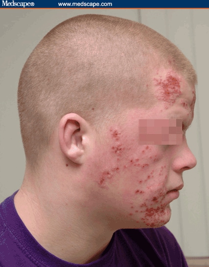 Photo Quiz: An Acute Vesiculobullous Rash on the Face ...