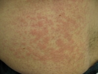 Urticaria from drug reaction. 