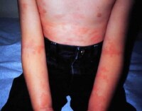 Urticaria associated with acute group A beta-hemol