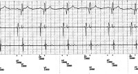 Telemetered ECG tracing showing atrioventricular (