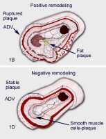 Positive and negative arterial remodeling. 