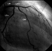 Selective left coronary artery angiogram demonstra