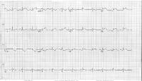 The electrocardiogram shows lateral ST-segment ele