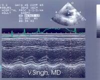 Hypokinesis of the anteroseptal wall observed duri