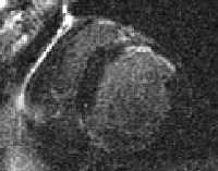 Image shows a scar in the anterior wall.