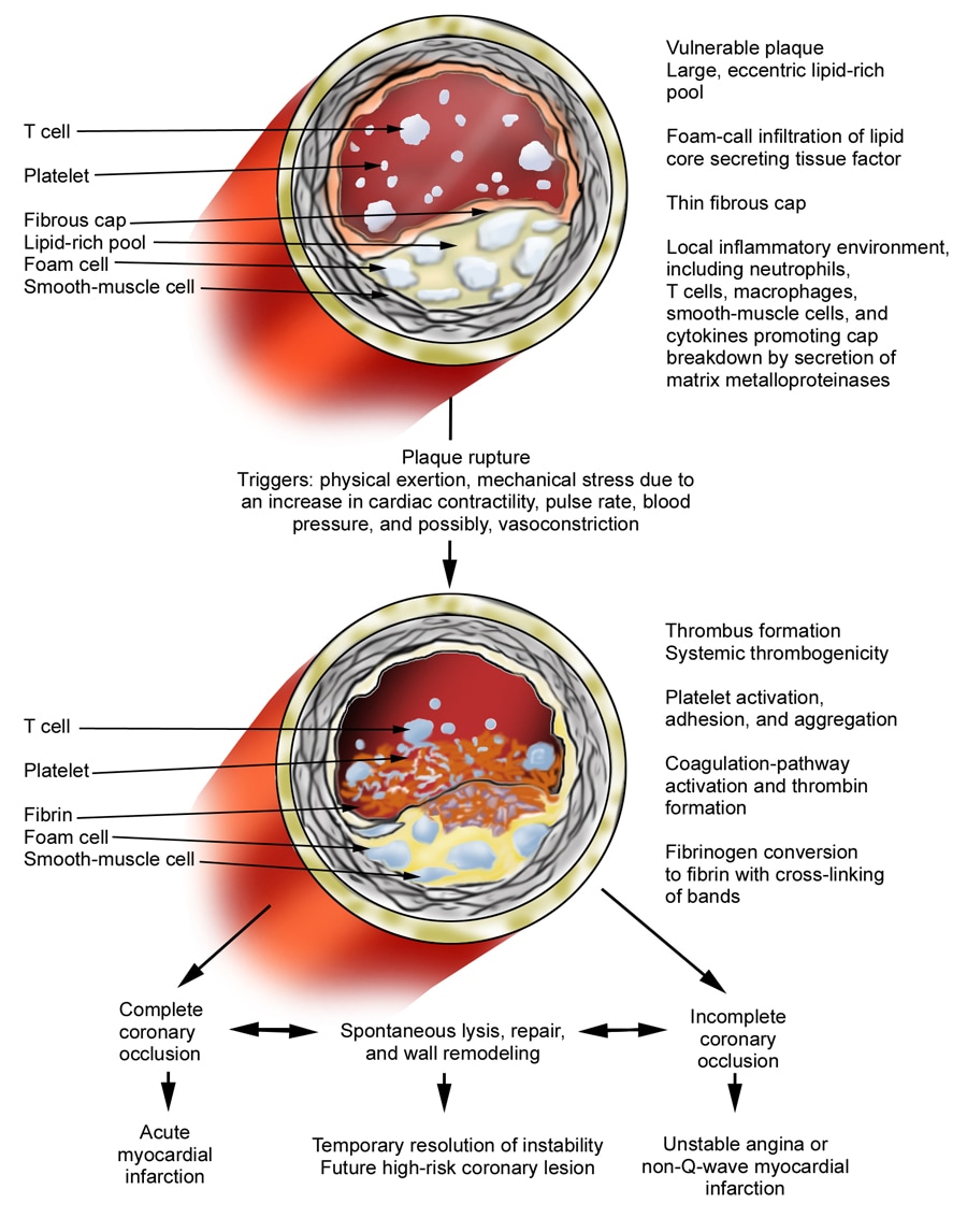 unstable-angina-pictures