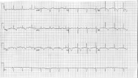 A 50-year-old man with type 1 diabetes mellitus an