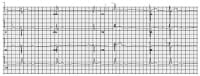 This ECG shows some typical abnormalities that may