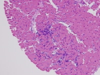 H and E, low power, showing numerous lymphocytes w