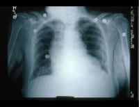 This chest radiograph shows an enlarged cardiac si