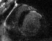 This magnetic resonance image shows a scar in the 