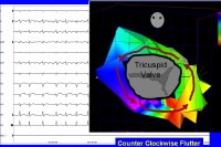 Type I counterclockwise atrial flutter. This 3-dim