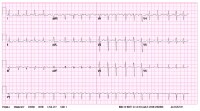 Atypical left atrial flutter. 