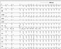 This 12-lead electrocardiogram demonstrates an atr
