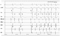 Note that the atrial activities originate from the