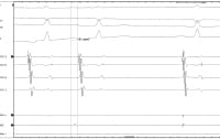 Intracardiac tracings showing atrial tachycardia b