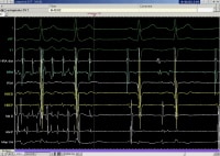 An example of rapid atrial tachycardia mimicking a