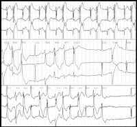 Bidirectional tachycardia in a patient with digita