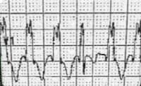 This ECG shows another form of idiopathic ventricu