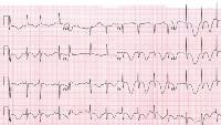 This 12-lead electrocardiogram is representative o