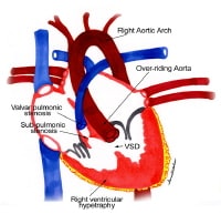 Anatomic findings in tetralogy of Fallot. 