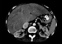 Cardiac cirrhosis. Congestive hepatopathy with lar