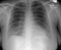 Noncardiogenic pulmonary edema in patient with pre
