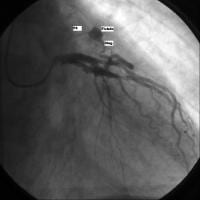 Coronary angiography showing the presence of a fis