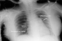 This radiograph reveals an enlarged right heart an