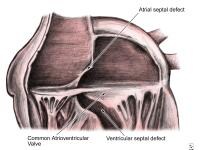Anatomy of the endocardial cushion defect (ie, com