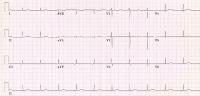 Note the retrograde P waves that precede each QRS 