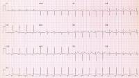 Accelerated junctional rhythm is present in this p
