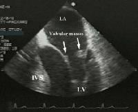 Transesophageal image of a mitral valve with masse