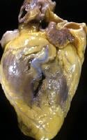 Photograph of heart of 43-year-old man demonstrati