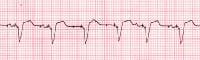 pacemaker failure to capture rhythm strip