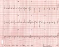 Sinus tachycardia. Note that the QRS complexes are
