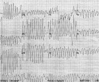 Atrial fibrillation in a patient with Wolff-Parkin