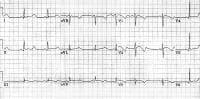 Marked prolongation of QT interval in a 15-year-ol