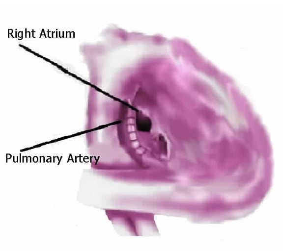 Blalock Park Procedure. Fontan procedure: Illustration