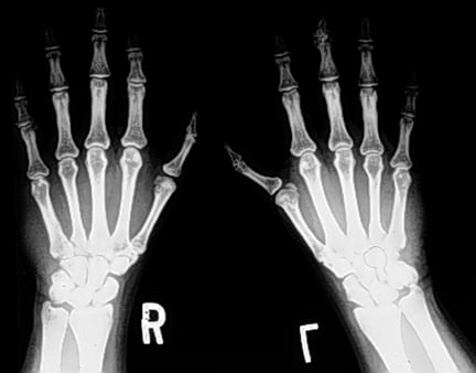 Posteroanterior radiograph of the hands of a patient with Holt-Oram syndrome 