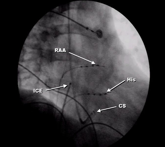  oblique view) of catheters used for atrial fibrillation ablation.