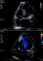 Modified 2-dimensional (top) echocardiogram and co
