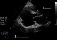 Parasternal long-axis view of the left ventricle d